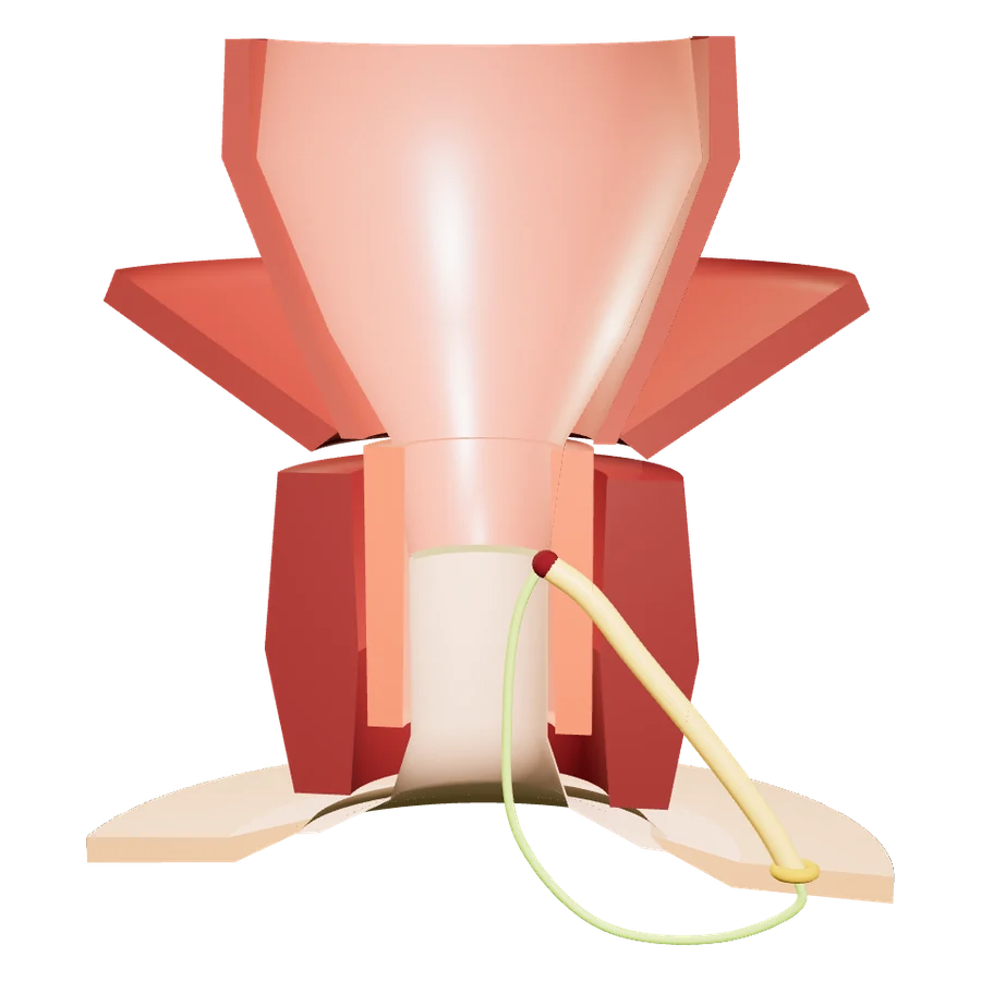 3D model of a fistula tunnel with a Kshar Sutra thread