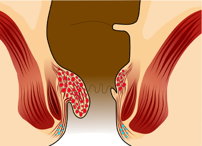 Piles (Haemorrhoids) anatomy