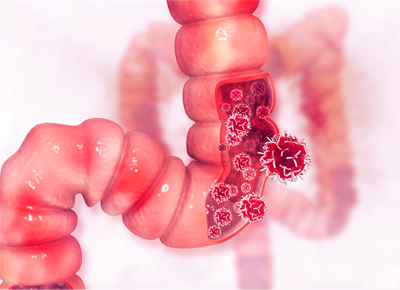 Rectal polyp anatomy